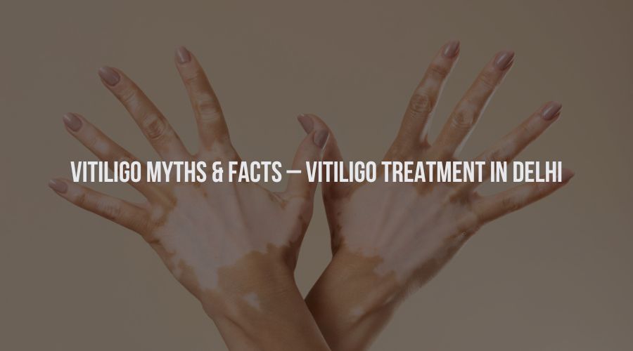 Vitiligo Myths & Facts – Vitiligo Treatment in Delhi