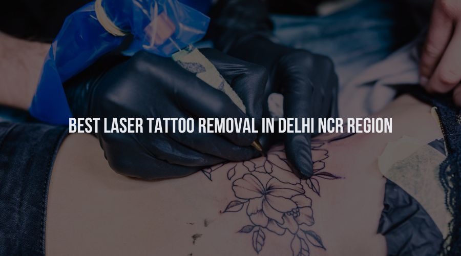 Best Laser Tattoo Removal in Delhi NCR Region