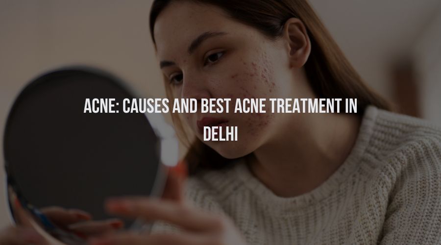 Acne: Causes and Best Acne Treatment in Delhi