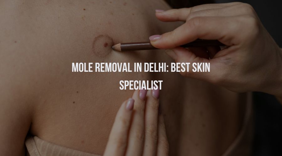 Mole Removal in Delhi: Best Skin Specialist