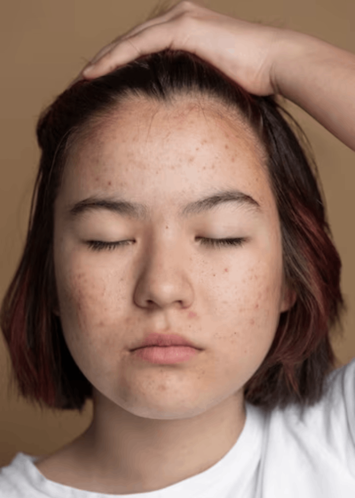 Acne Treatment in Delhi