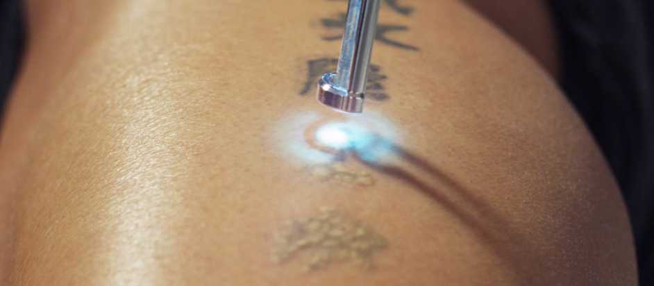 How to Remove a Tattoo for Good - Tannan Plastic Surgery | Raleigh, Chapel  Hill, Durham, NC