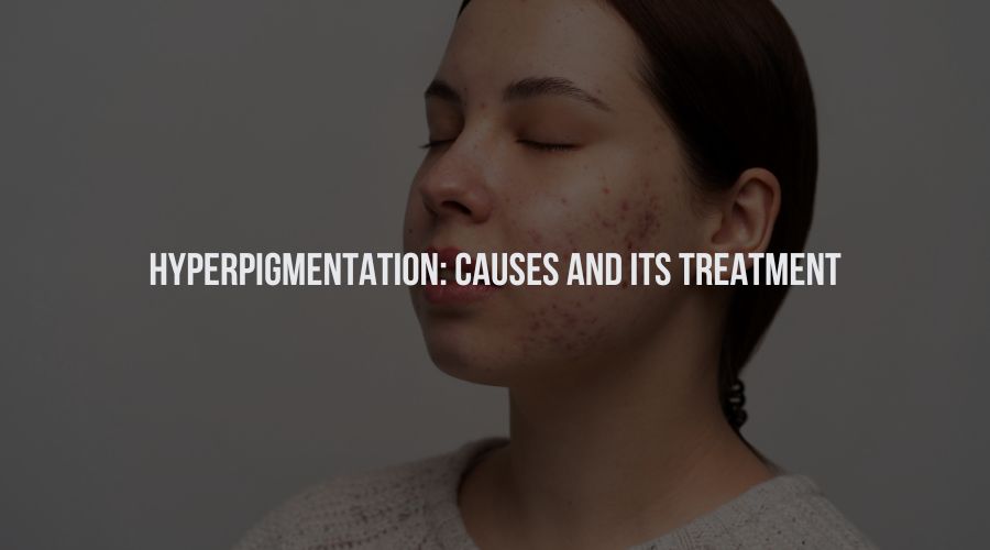 Hyperpigmentation: Causes and Its Treatment