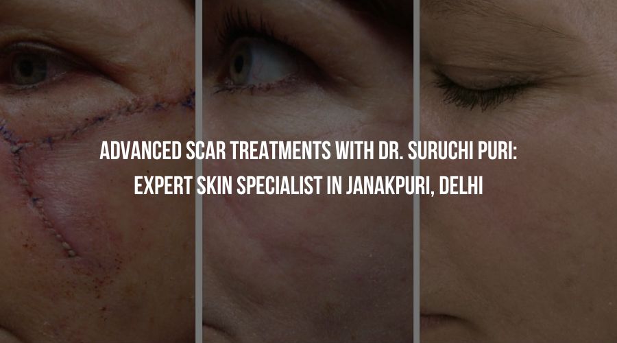 Advanced Scar Treatments with Dr. Suruchi Puri: Expert Skin Specialist in Janakpuri, Delhi