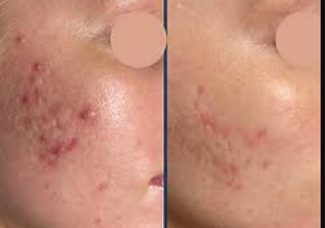 Acne scar correction treatment with PDRN therapy for smoother and clearer skin