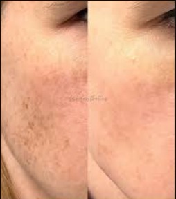 Pigmentation Improvement​