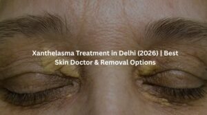 Xanthelasma Treatment in Delhi by Dr Suruchi Puri