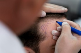 Natural hairline tattoo blending procedure with scalp marking for realistic hairline enhancement.