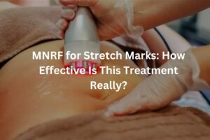 MNRF treatment for stretch marks to improve skin texture and reduce visible marks