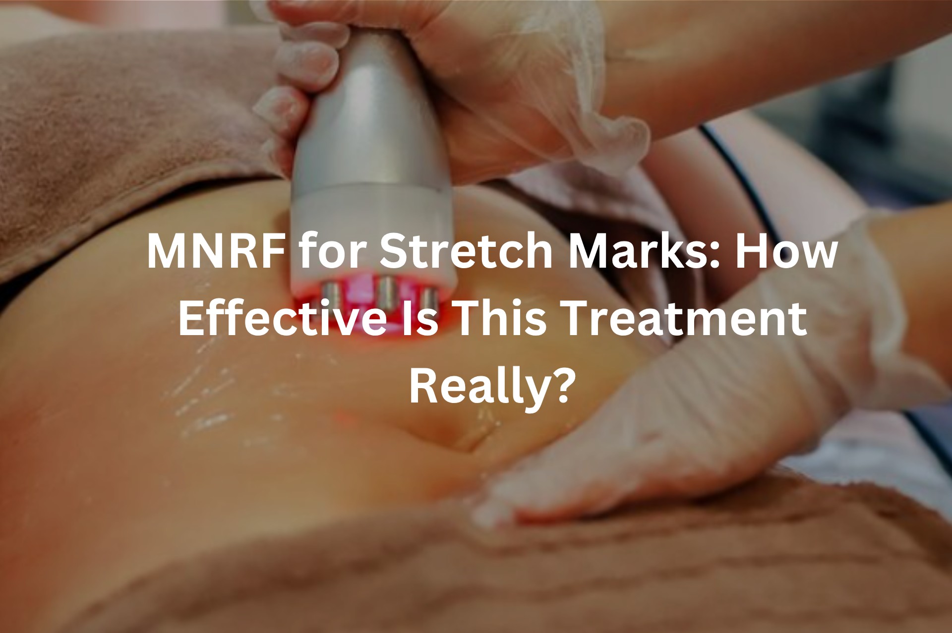 MNRF for Stretch Marks: How Effective Is This Treatment Really?