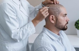 Scalp micropigmentation consultation and hairline design session with a specialist marking a customized hairline on a patient’s scalp.