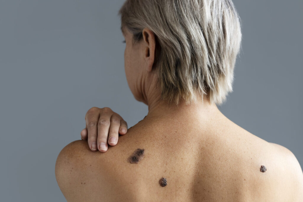 Early skin cancer symptoms and warning signs explained by a skin specialist