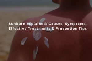 Person experiencing sunburn on the skin after prolonged sun exposure, showing redness and irritation caused by UV rays.