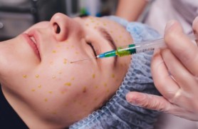 Biofiller treatment for acne scars and skin texture improvement