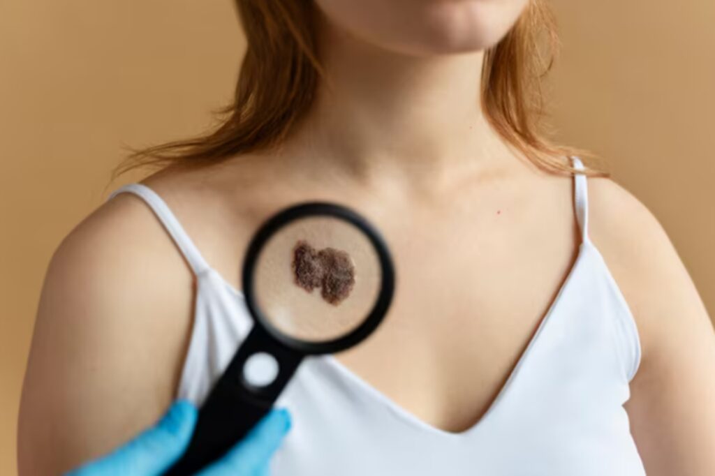 Mole removal treatment performed by a dermatologist using advanced skin care techniques