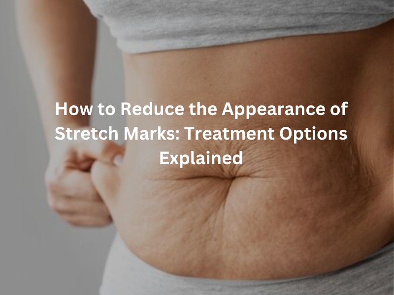 How to Reduce the Appearance of Stretch Marks: Treatment Options Explained