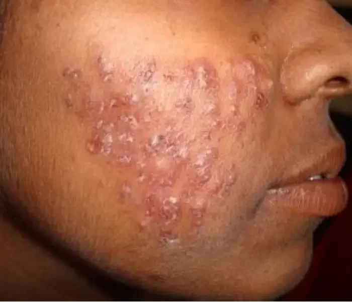 Acne Treatment (1)