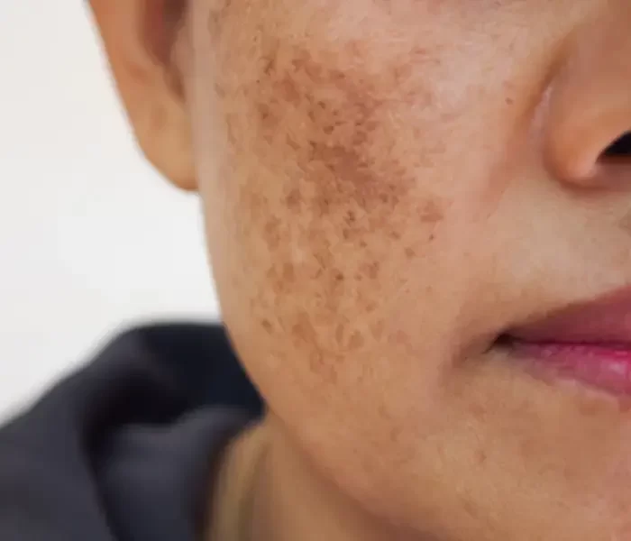 Freckles and Sunspot Treatment