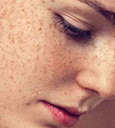 Freckless And Sunspots Treatment