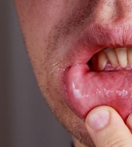 mouth-ulcer