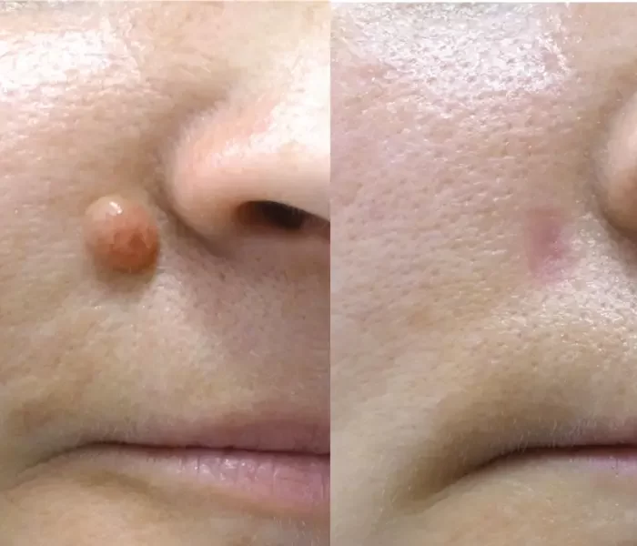 Warts and Moles Removal Treatment