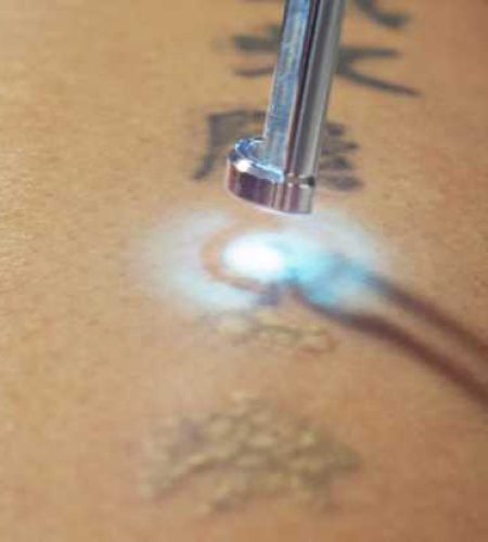 Laser Tattoo Removal – Tattoo Off – Palm Desert – La Quinta